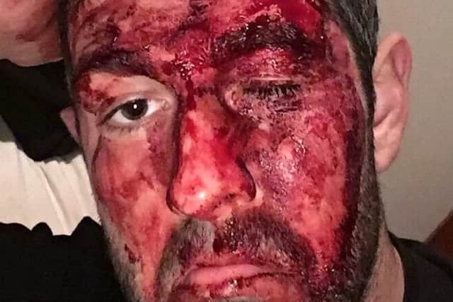 Former cage fighter Euan Fraser, 30, shows his injuries after being attacked with a crowbar by his taxi driver in Melbourne, Australia. Picture: SWNS