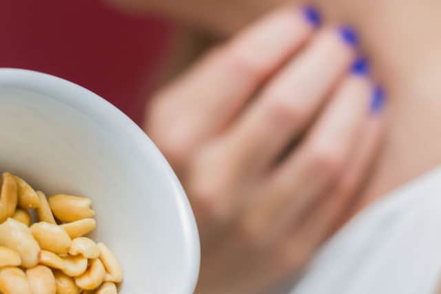 Peanut allergy sufferers have been given new hope following the results of a landmark study.