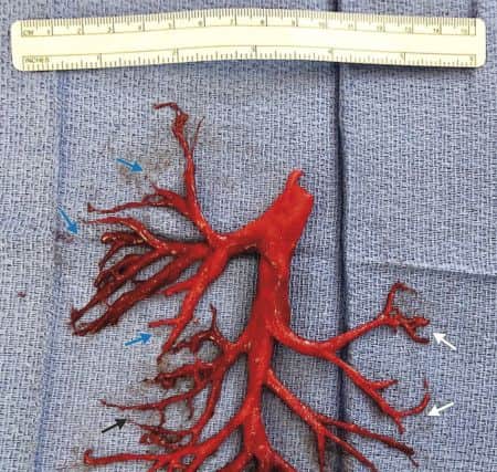 The six-inch-wide blood clot that was coughed up by an unnamed patient in the near-perfect shape of his right bronchial tree. Picture: New England Journal of Medicine/PA Wire