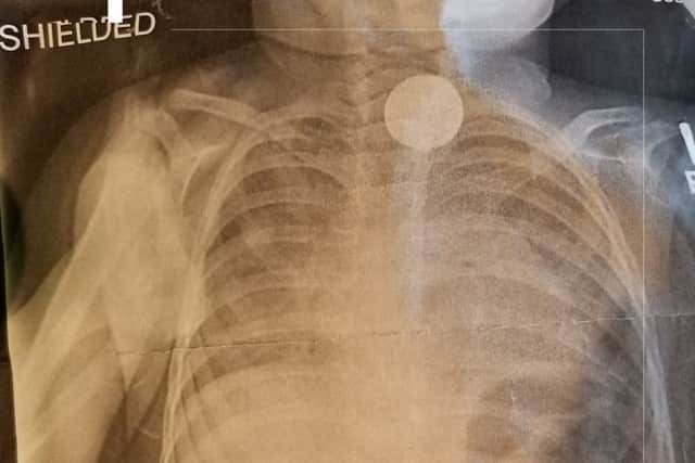 An Xray revealed Abigayle had a battery in her esophagus. Picture: SWNS