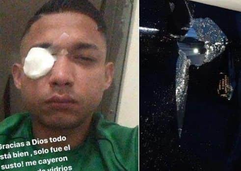 Emilio Izaguirre was hit in the eye by glass after bus windows were smashed. Picture: contributed