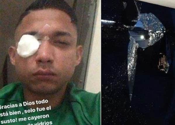Emilio Izaguirre was hit in the eye by glass after bus windows were smashed. Picture: contributed