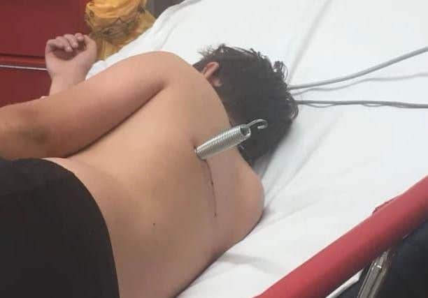 Jamie Quinlan (12), pictured with the metal spring embedded six centimetres into his back. Picture: Louth Leader