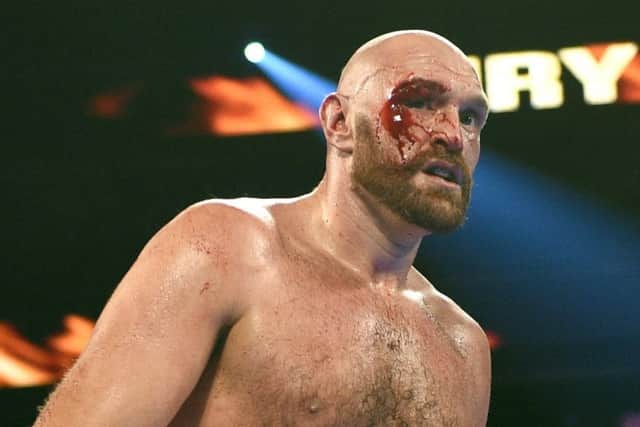 Tyson Fury sustained a gaping gash over his right eye and also a smaller one on the eyelid. Picture: Getty.