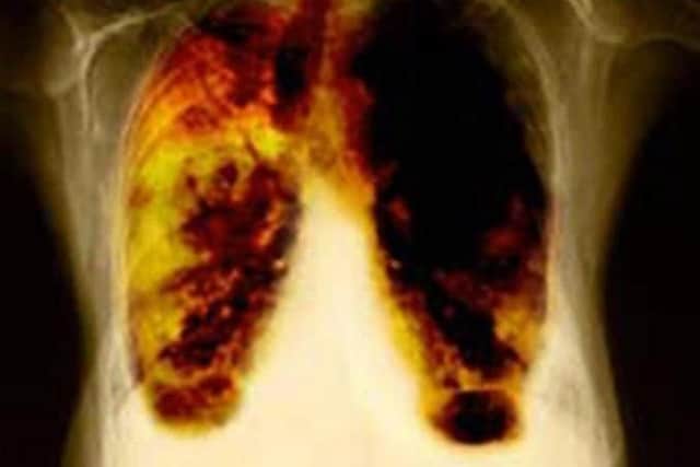 One person dies of lung disease and five more are diagnosed with the condition every five minutes in the UK, according to a new report. picture: PA