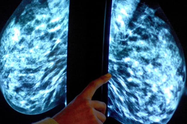 Breast cancer screening rates in Scotland fall
