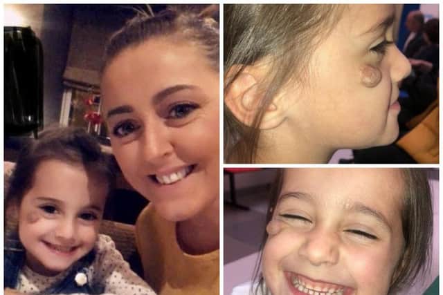 Little Laila McLatchie said children and adults 'point and laugh' at the ulcerated hemangioma growth on her face which she has had since birth. Picture: Laura McLatchie/SWNS