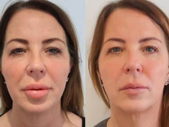 Kay Smith, 53, said her lips blew up just like the Men Behaving Badly actress.