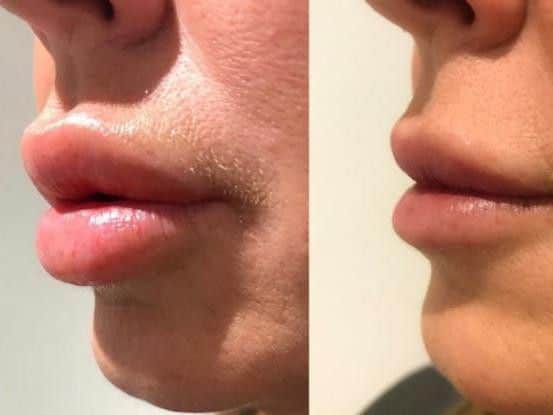 Her case was made worse by the fact that the filler expanded with a rise in temperature, so every time she went on holiday to the sun her lips got even bigger.