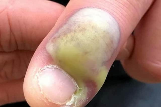Steven MacDonald was rushed to hospital just days after noticing his left index finger had become infected. Picture: SWNS