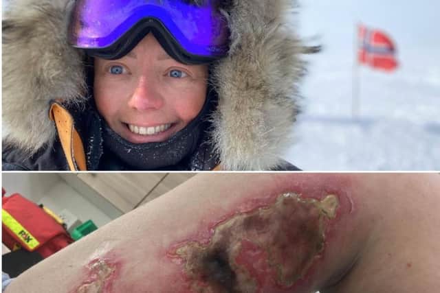 Jenny Davis on her expedition and the extent of her condition on her return home. Picture: Jenny Davis